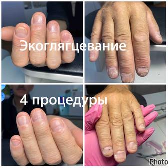 Лечение ногтей