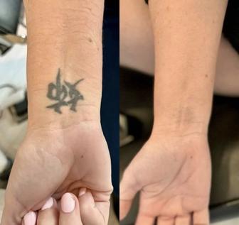 Удаление татуировок, Растушёвка АКЦИЯ-50%